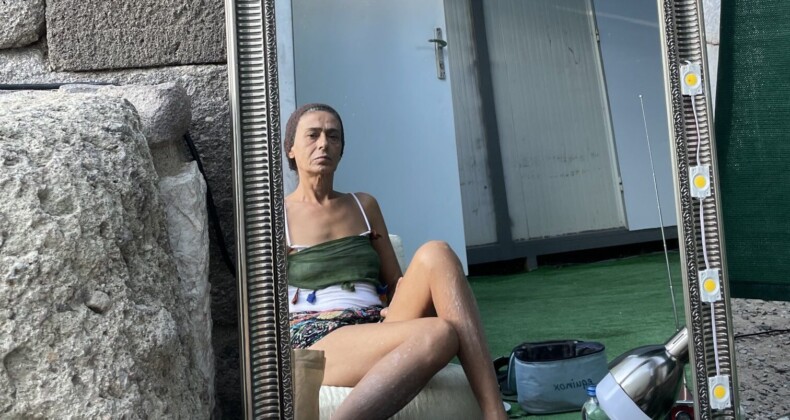 Yıldız Tilbe’nin bacağındaki lekeler korkuttu!