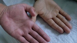 Çok Nadir Görülüyor! Aplastik Anemi Hastalığı Nedir?