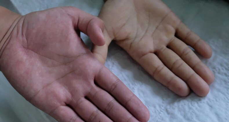 Çok Nadir Görülüyor! Aplastik Anemi Hastalığı Nedir?