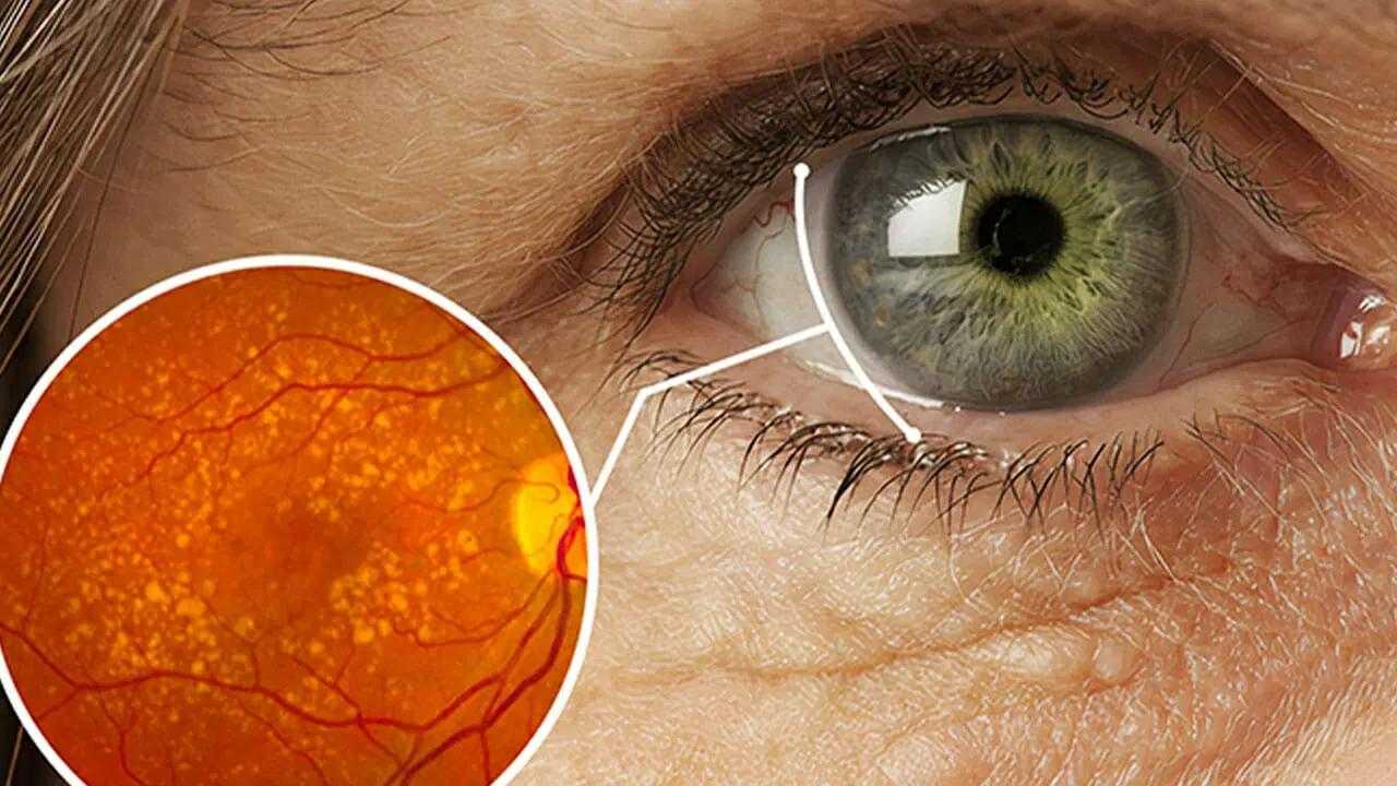 Gözde Sarı Nokta Hastalığı Nedir, Tedavisi Var Mı? 3 sari nokta hastaligi nedir tedavisi var mi gozde sari nokta hastaligi neden olur XmGffOKA