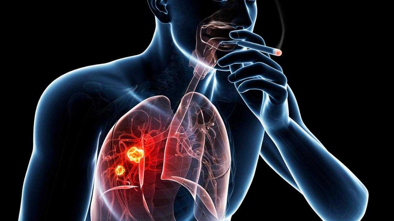 her yil 300 bin kisi oluyor koah hastaligi nedir belirtileri nelerdir 3 rugAyD6X