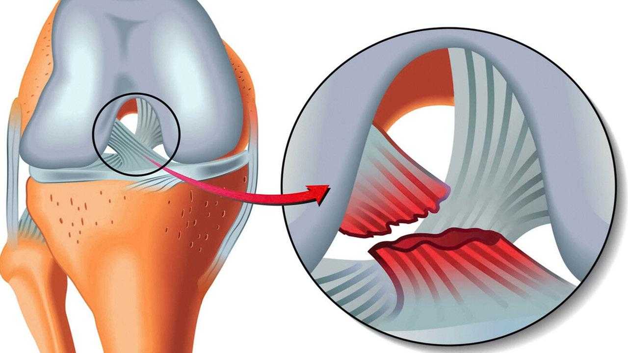 Menisküs Yırtılması Nedir, Nasıl Geçer? Menisküs Yırtığı Belirtisi ve Tedavisi Nedir? 1 meniskus yirtilmasi nedir nasil gecer meniskus yirtigi belirtisi ve tedavisi nedir 1 VQccWNR6
