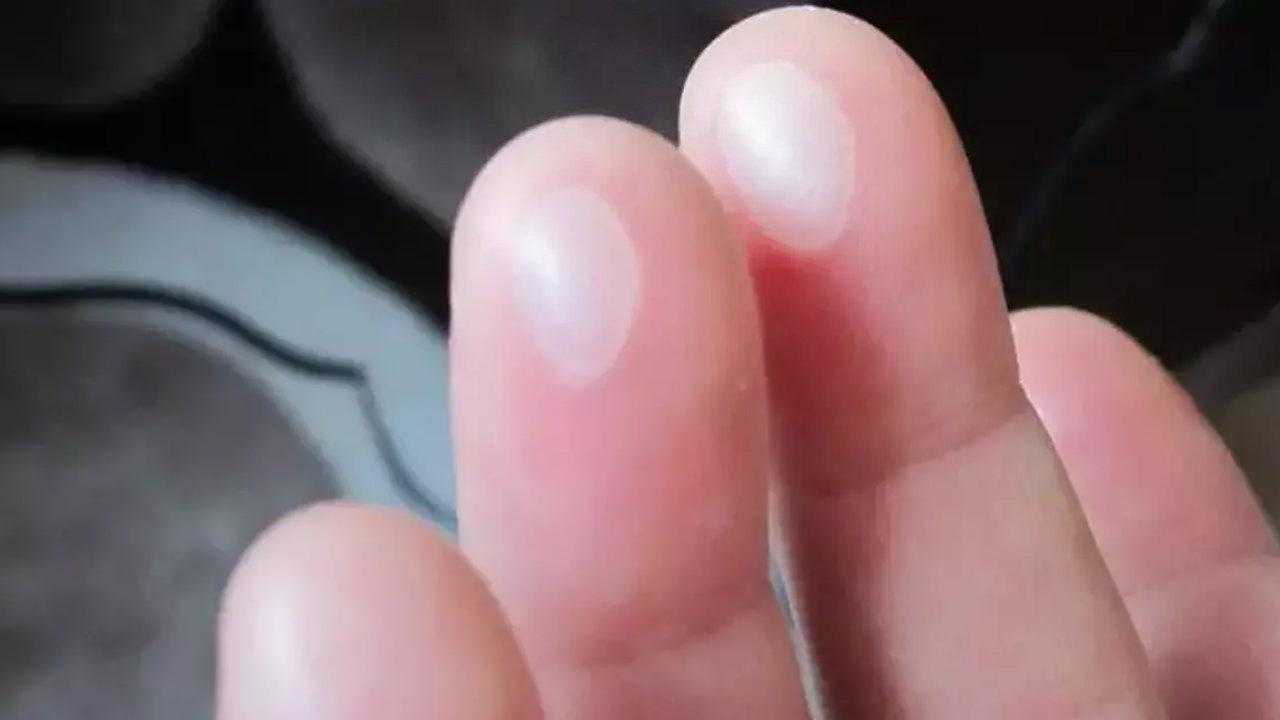 Yanık Su Toplaması Nasıl, Kaç Günde Geçer? Su Toplayan Yanık Patlarsa Ne Yapmalı, İz Bırakır mı? 2 yanik su toplamasi nasil kac gunde gecer su toplayan yanik patlarsa ne yapmali iz R7HlQrtJ