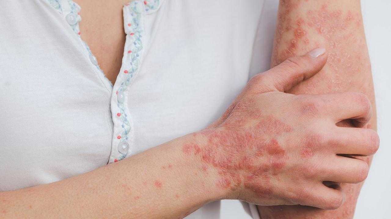 Lupus Hastalığı Ölümcül Müdür, Neden Olur? Lupus Hastalığı Tedavisi Nedir? 1 lupus hastaligi olumcul mudur neden olur lupus hastaligi tedavisi nedir 1 mVWEk78i