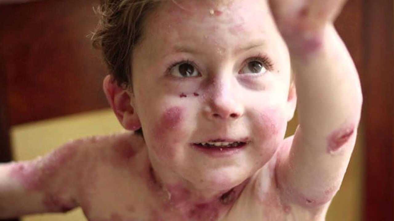 Lupus Hastalığı Ölümcül Müdür, Neden Olur? Lupus Hastalığı Tedavisi Nedir? 2 lupus hastaligi olumcul mudur neden olur lupus hastaligi tedavisi nedir 2