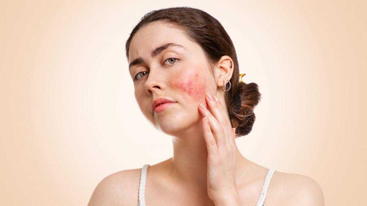 Lupus Hastalığı Ölümcül Müdür, Neden Olur? Lupus Hastalığı Tedavisi Nedir? 3 lupus hastaligi olumcul mudur neden olur lupus hastaligi tedavisi nedir 3 aYCjSGhz