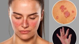 Lupus Hastalığı Ölümcül Müdür, Neden Olur? Lupus Hastalığı Tedavisi Nedir?
