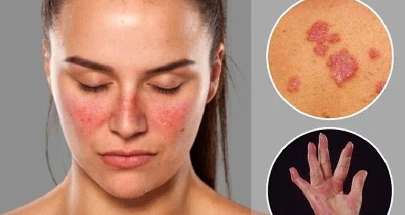 Lupus Hastalığı Ölümcül Müdür, Neden Olur? Lupus Hastalığı Tedavisi Nedir?