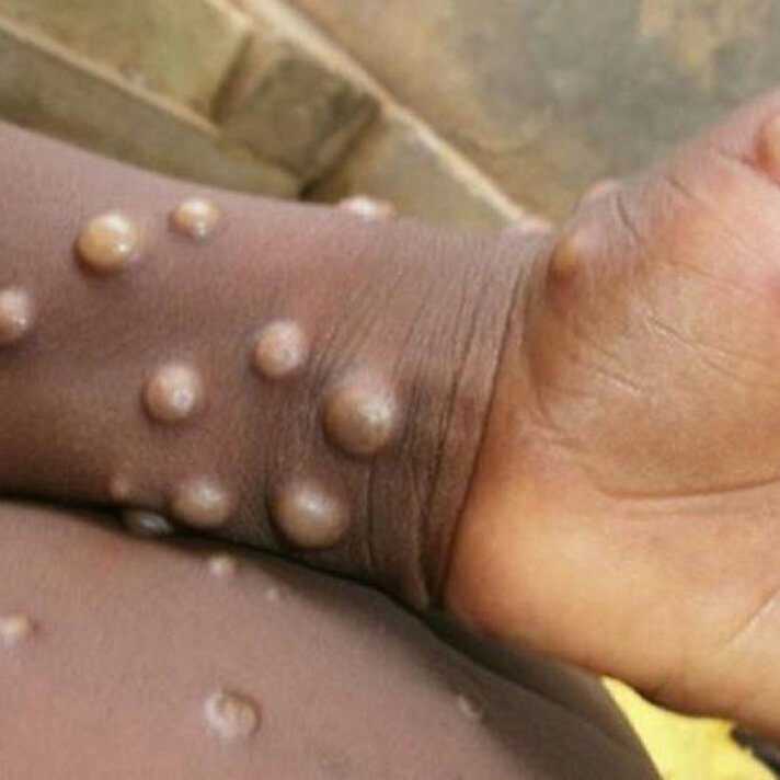 DSÖ'den Kritik Mpox Açıklaması: Kapanma Gündemde Mi? 2 GU9 BI9WYAAA1R9 1