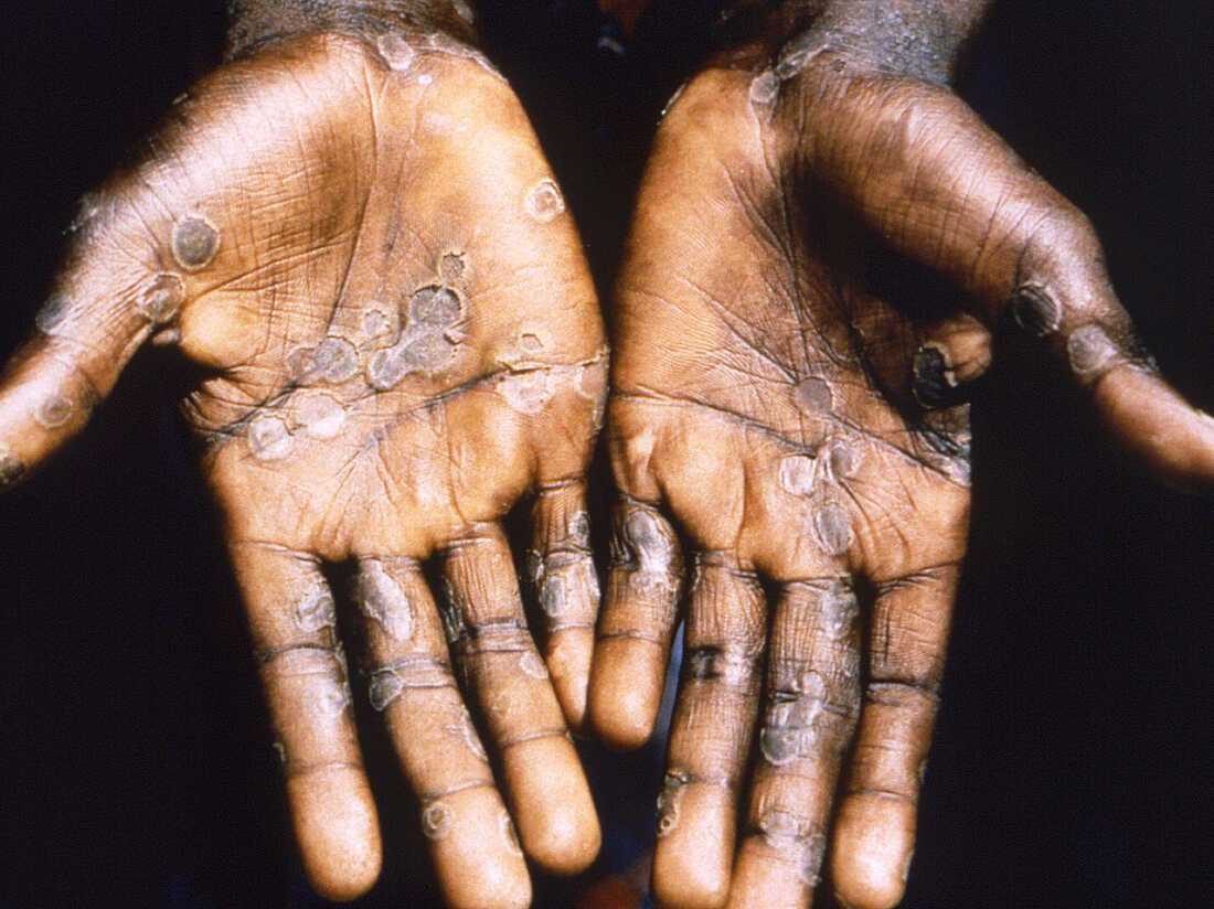 DSÖ'den Kritik Mpox Açıklaması: Kapanma Gündemde Mi? 1 GU9 BKJXIAABWT2 1