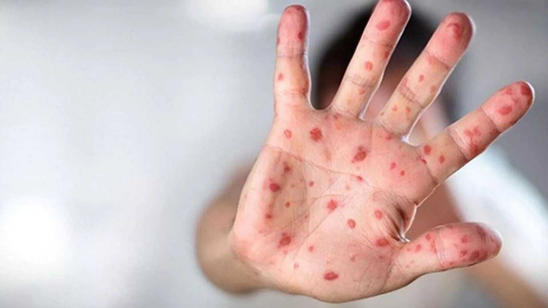 M Çiçeği Alarmı: Çocuklar Ölümcül Tehlike Altında! 3 GVMVdEoWcAEwktR