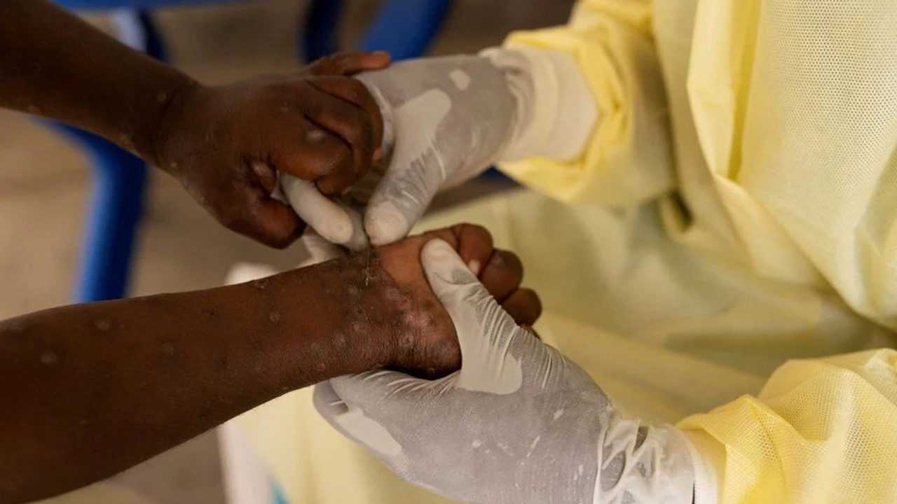 Istanbulda Mpox Krizi Havalimani Alarmda 2