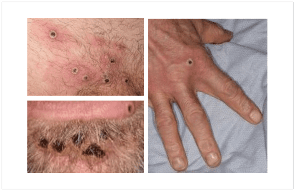 Türkiye Mpox Alarmında mı? Bakanlıktan Kritik Açıklama! 1 monkeypox 2 0