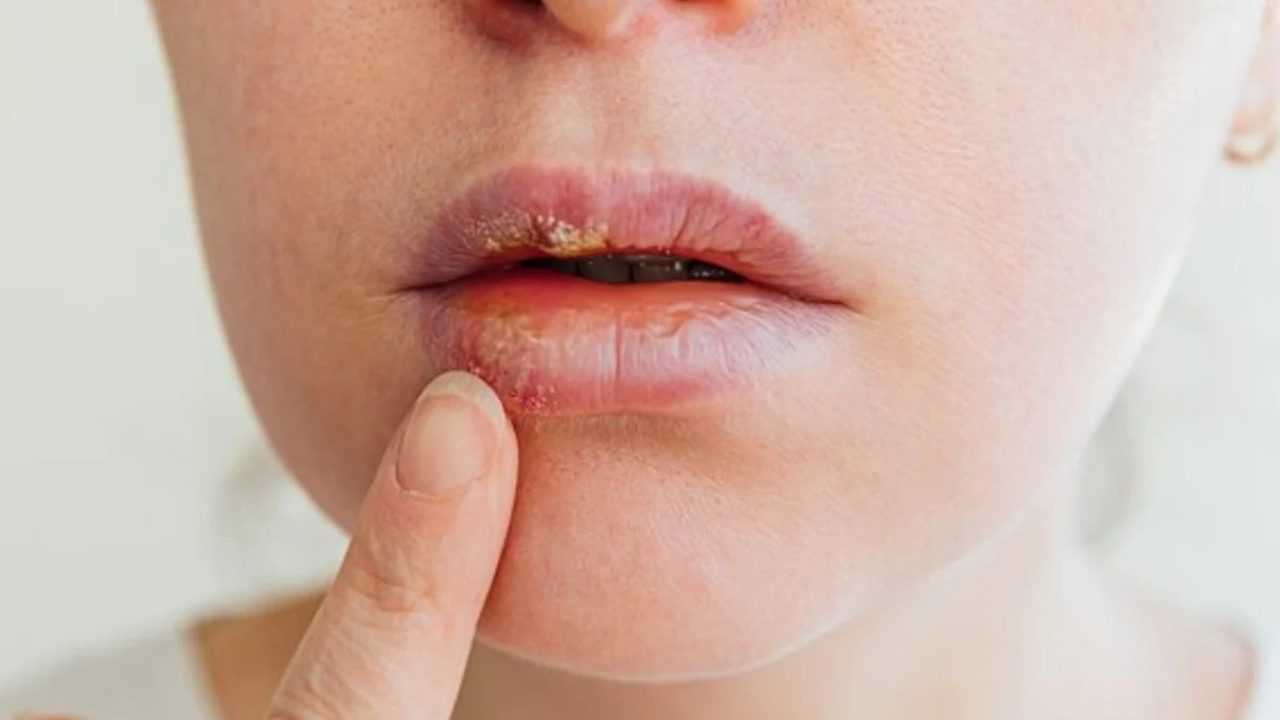Uçuk Kabusuna Son: 10 Dakikada Geçiren Yöntem 6 Ucuk Kabusuna Son 10 Dakikada Geciren Yontem 7