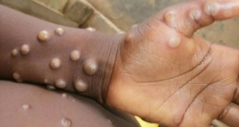 Sierra Leone’de M Çiçeği Virüsü Alarmı