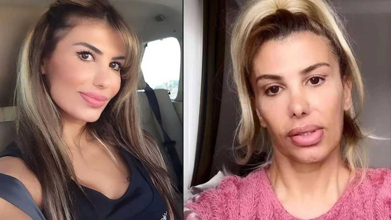 Hatice’nin Kâbusu: Botoks Sonrası Zehirlendi 2 Haticenin Kabusu Botoks Sonrasi Zehirlendi 3